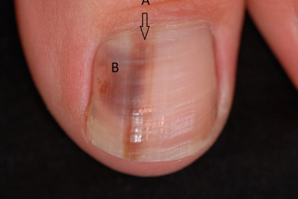 Інформація про меланому на пальці і шкірі ноги
