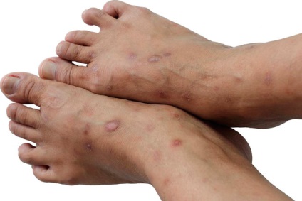 Információ melanoma bőr az ujjak és a láb