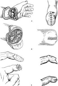 Contracția ischemică a mâinii și a degetelor, defectele amputare ale mâinii și degetelor, traumatologist ro