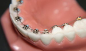 Як брекети вирівнюють зуби скільки коштує посмішка на мільйон про виправлення прикусу і брекети
