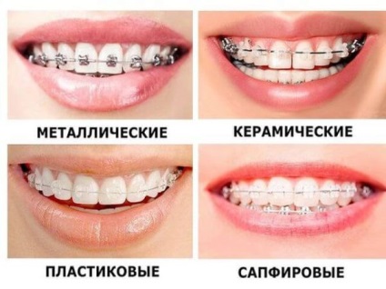 Як брекети вирівнюють зуби скільки коштує посмішка на мільйон про виправлення прикусу і брекети