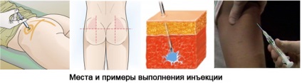 Як робити уколи внутрішньом'язово - фатальна енергія