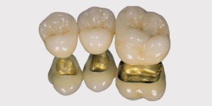 Ce fel de coroane este mai bine să puneți pe dinții de mestecat tipuri de proteze și sfaturi
