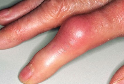 Які уколи застосовую при артриті