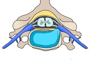 Care sunt simptomele și tratamentul herniei intervertebrale a regiunii toracice