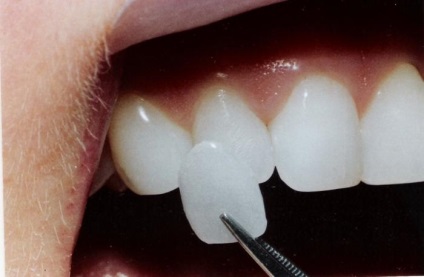 Як прибрати щілину між зубами (диаст)