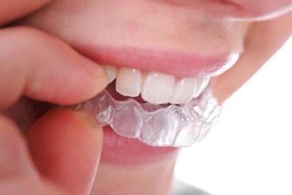 Як прибрати щілину між зубами (диаст)