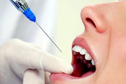 Карієс між зубами лікування