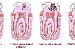 Caries între tratamentul dinților