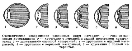 Катаракта причини, симптоми, діагностика, лікування хвороби