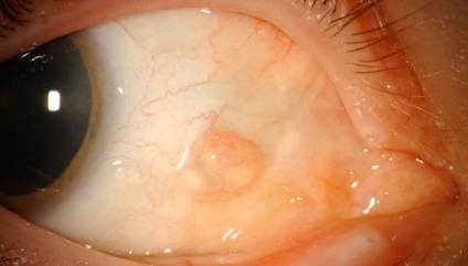 Chistul cauzelor ochiului conjunctival, simptomele și tratamentul eficient al bolii