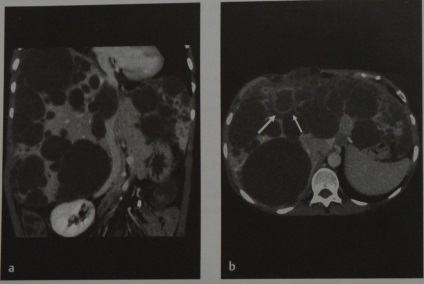 Chisturile hepatice