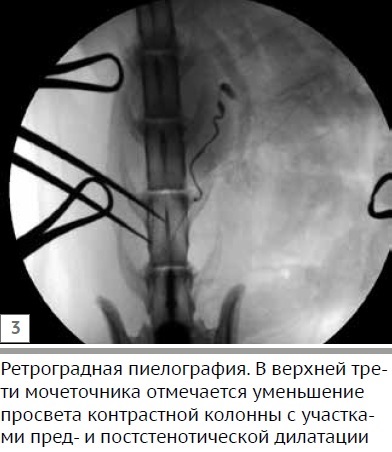 Клінічний випадок стенозу сечоводу у кота при аномалії розвитку каудальной порожнистої вени