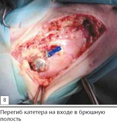 Клінічний випадок стенозу сечоводу у кота при аномалії розвитку каудальной порожнистої вени