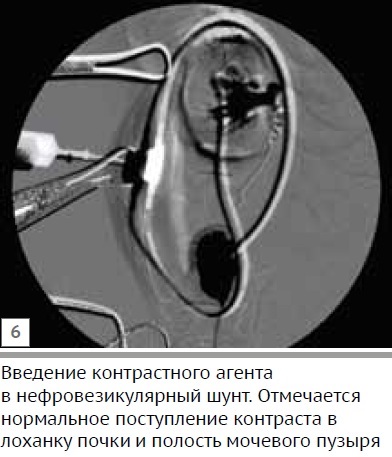 Klinikai esetén uréter szűkület egy macska abnormális fejlődése a caudalis vena cava