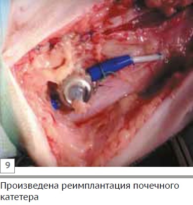 Klinikai esetén uréter szűkület egy macska abnormális fejlődése a caudalis vena cava