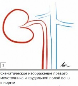 Клінічний випадок стенозу сечоводу у кота при аномалії розвитку каудальной порожнистої вени