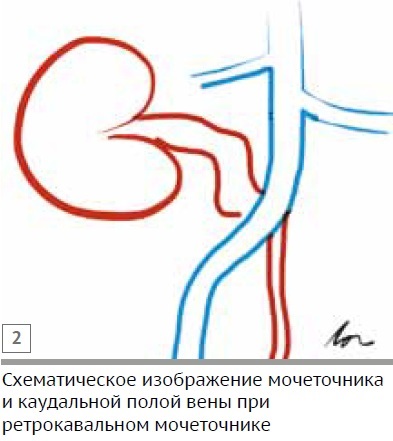 Caz clinic de stenoză a ureterului la o pisică cu o anomalie de dezvoltare a venei cava caudale