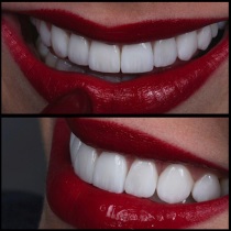 Клініка створення красивої посмішки insmile veneers center