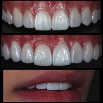 Клініка створення красивої посмішки insmile veneers center