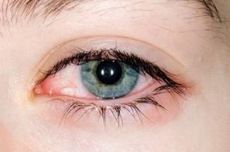 Червено око причинява протеини при кърмачета, окото, насочете детето, уморен, защо постоянно