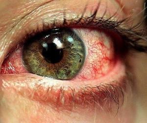 Червено око причинява протеини при кърмачета, окото, насочете детето, уморен, защо постоянно