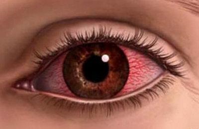 Червоні білки очей причини у грудничка, сітка, точка у дитини, втомлені, чому постійно