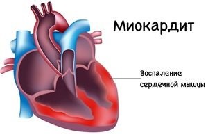 Ку-лихоманка симптоми, лікування, профілактика