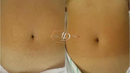 Ablatia abdomenului prin laser - dor