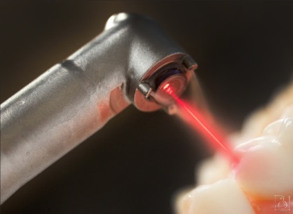 Implantarea cu laser în stomatologie