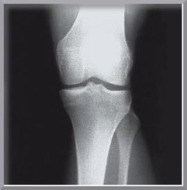 Лікування артрозу колінного суглоба, здоровий спосіб життя