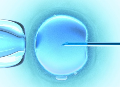 Meddőségorvoslás IVF