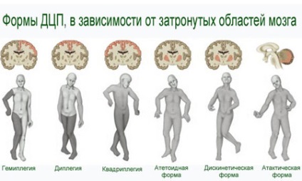 Лікування дітей з ДЦП, лікування дитини - дитячі хвороби, консультації, досвід