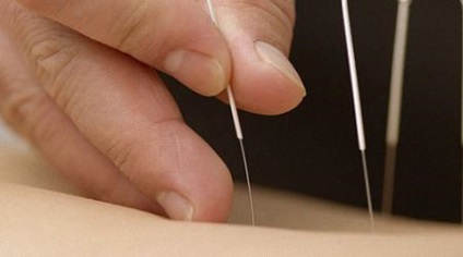 Tratamentul cu acupunctura