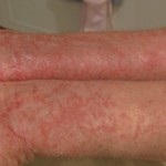 Tratamentul eczemelor moccasive, eczemelor