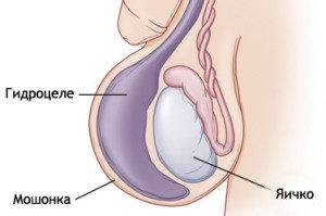 Лікування варикоцеле у чоловіків, як лікувати і методи лікування варикоцеле яєчка