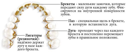 Lingual braces în spb prețuri, recenzii, fotografii, costul de bretele linguale