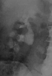 Ectazia tubulară renală medulară spongioasă și boala cacchi-ricci