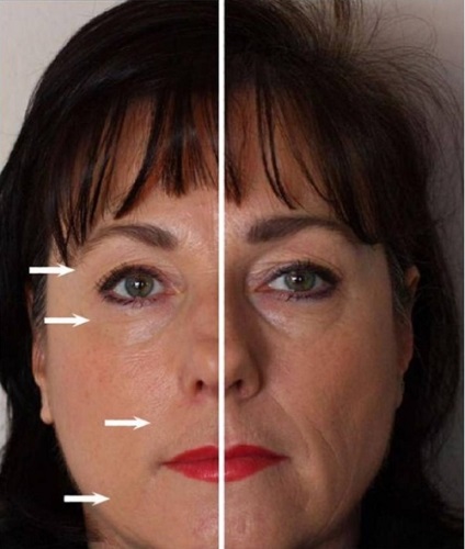 Мікроструми (мікрострумова терапія) в косметології - ціни, протипоказання, фото до і після