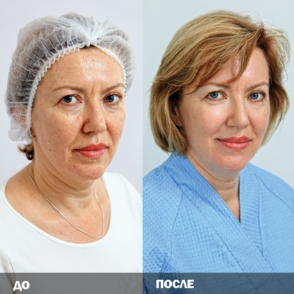 Microcurrents (terapie cu microcurrent) în cosmetologie - prețuri, contraindicații, fotografii înainte și după