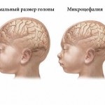 Мікроцефалія у дітей, секрети народної медицини