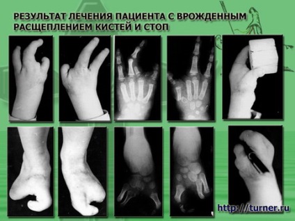 Мікрохірургіческаяаутотрансплантація пальців стоп на кисть у дітей з вродженими іпріобретеннимі