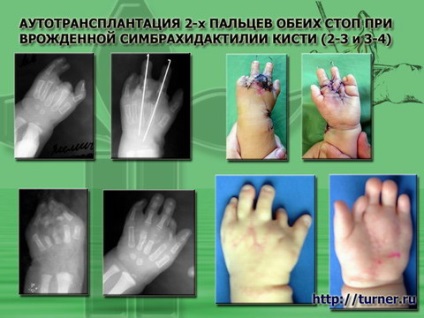 Мікрохірургіческаяаутотрансплантація пальців стоп на кисть у дітей з вродженими іпріобретеннимі