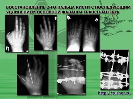 Мікрохірургіческаяаутотрансплантація пальців стоп на кисть у дітей з вродженими іпріобретеннимі