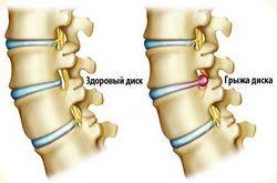 Tudok sportolni spinális sérv - orvosok Clinic Mr. Ignatieff