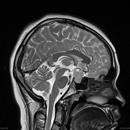 MRI az agyalapi