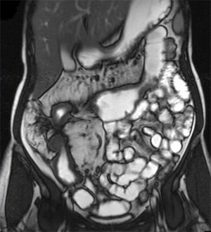 Mut intestinal - diagnostic intestinal