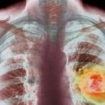 Lipsa oxigenului provoacă cancer