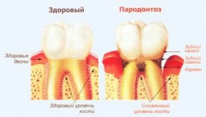 O nouă descoperire în tratamentul parodontitei - medicamente pentru tratamentul și prevenirea osteoporozelor osteomediu și