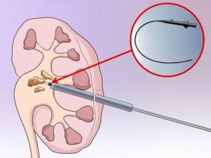 Операція з видалення каменів у нирках методи дроблення, усунення причин каменеутворення